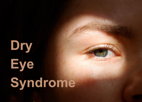 Dry Eye Syndrome