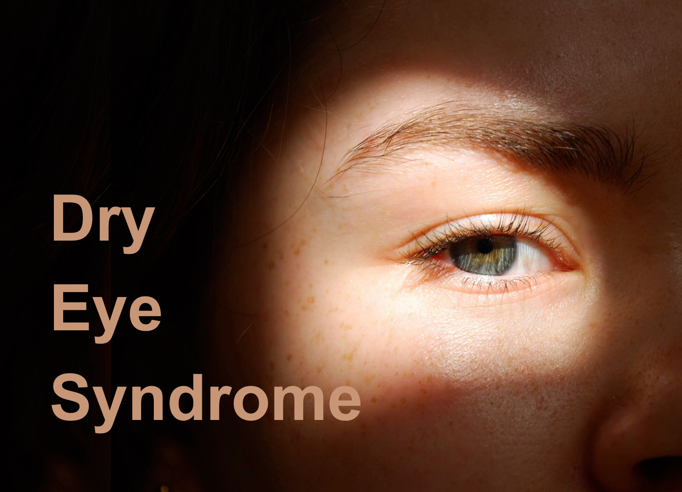 Dry Eye Syndrome Effective Treatments and Prevention Tips